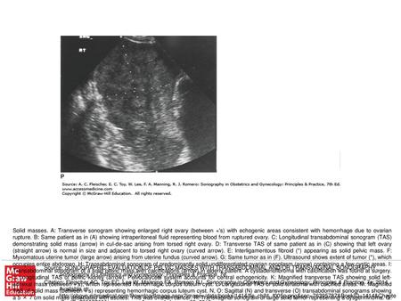 Solid masses. A: Transverse sonogram showing enlarged right ovary (between +'s) with echogenic areas consistent with hemorrhage due to ovarian rupture.