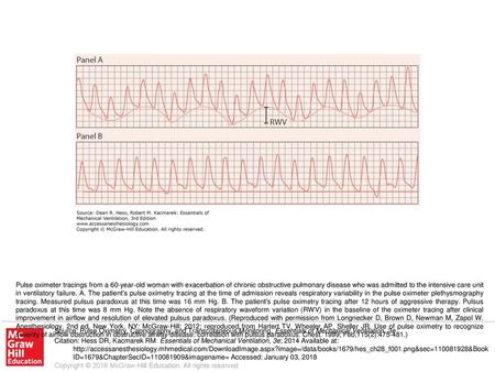 Pulse oximeter tracings from a 60-year-old woman with exacerbation of chronic obstructive pulmonary disease who was admitted to the intensive care unit.