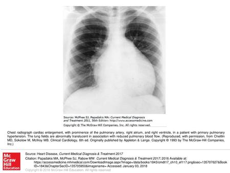 Chest radiograph cardiac enlargement, with prominence of the pulmonary artery, right atrium, and right ventricle, in a patient with primary pulmonary hypertension.