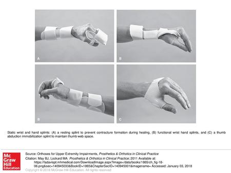 Static wrist and hand splints: (A) a resting splint to prevent contracture formation during healing, (B) functional wrist hand splints, and (C) a thumb.