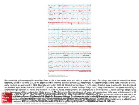 Representative polysomnographic recordings from adults in the awake state and various stages of sleep. Recordings are made at conventional sleep laboratory.