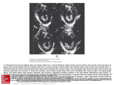 A. Parasternal views during diastole (left) and systole (right) from a normal individual. Upper panels: long-axis plane; lower panels: short-axis plane.