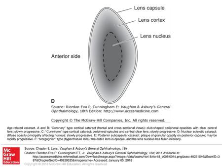 Age-related cataract. A and B: “Coronary” type cortical cataract (frontal and cross-sectional views): club-shaped peripheral opacities with clear central.