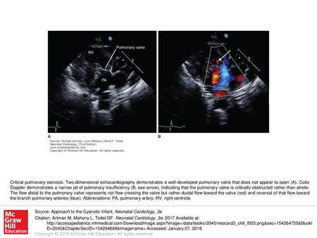 Critical pulmonary stenosis