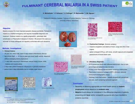 FULMINANT CEREBRAL MALARIA IN A SWISS PATIENT