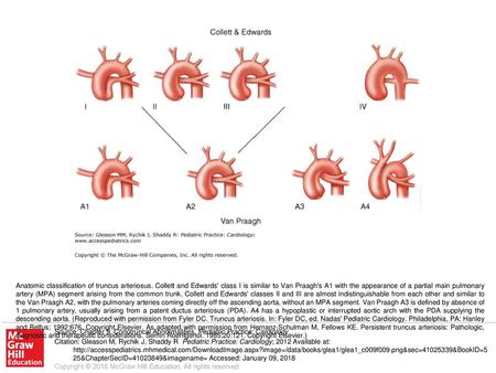 Anatomic classification of truncus arteriosus