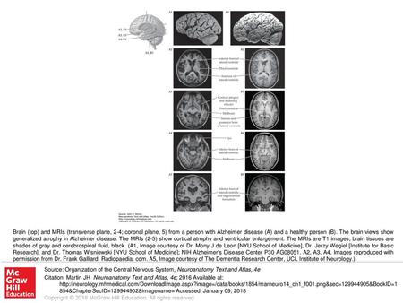 Brain (top) and MRIs (transverse plane, 2-4; coronal plane, 5) from a person with Alzheimer disease (A) and a healthy person (B). The brain views show.