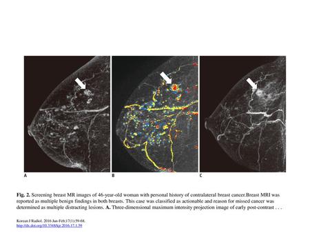 Fig. 2. Screening breast MR images of 46-year-old woman with personal history of contralateral breast cancer.Breast MRI was reported as multiple benign.