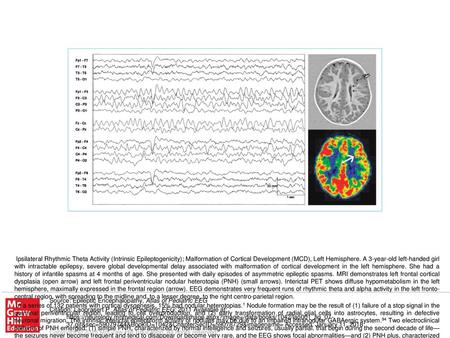 The best predictor of surgical outcome is the presence of a focal epileptic generator that may or may not include the PNH. Invasive recording is required.