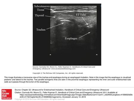 This image illustrates a transverse view of the trachea and esophagus during an esophageal intubation. Note in this image that the esophagus is visualized.