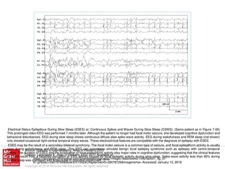 ESES may be the result of a secondary bilateral synchrony