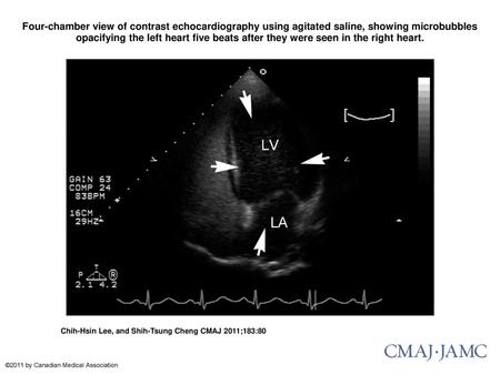 Four-chamber view of contrast echocardiography using agitated saline, showing microbubbles opacifying the left heart five beats after they were seen in.