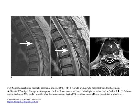 Fig. 3.Lumbosacral spine magnetic resonance imaging (MRI) of 48-year-old woman who presented with low back pain. A. Sagittal T2-weighted image shows asymmetric.