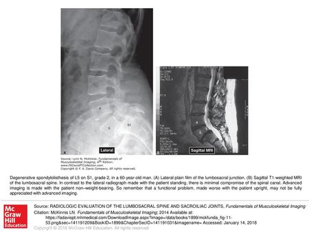 Degenerative spondylolisthesis of L5 on S1, grade 2, in a 60-year-old man. (A) Lateral plain film of the lumbosacral junction. (B) Sagittal T1-weighted.