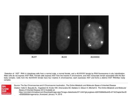 Detection of XIST RNA in interphase cells from a normal male, a normal female, and a 49,XXXXX female by RNA fluorescence in situ hybridization. Male.