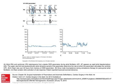 (A) Atrial (RA) and ventricular (RV) electrograms from unipolar DDD pacemaker during atrial fibrillation (AF). AF appears as rapid atrial depolarizations.