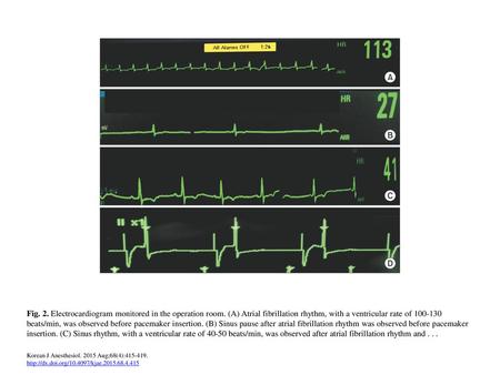 Fig. 2. Electrocardiogram monitored in the operation room