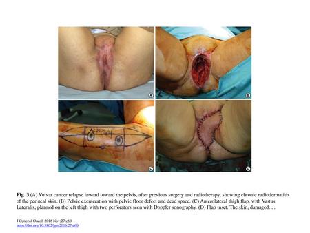 Fig. 3.(A) Vulvar cancer relapse inward toward the pelvis, after previous surgery and radiotherapy, showing chronic radiodermatitis of the perineal skin.