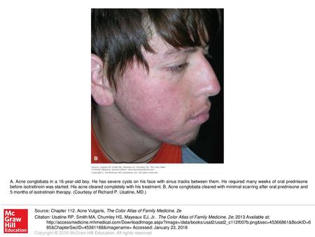 A. Acne conglobata in a 16-year-old boy