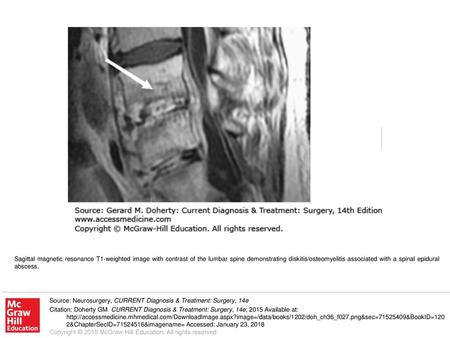 Sagittal magnetic resonance T1-weighted image with contrast of the lumbar spine demonstrating diskitis/osteomyelitis associated with a spinal epidural.