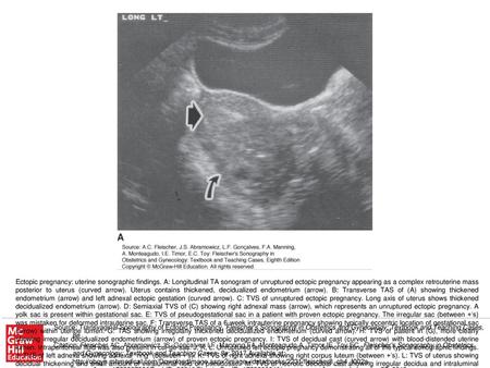 Ectopic pregnancy: uterine sonographic findings