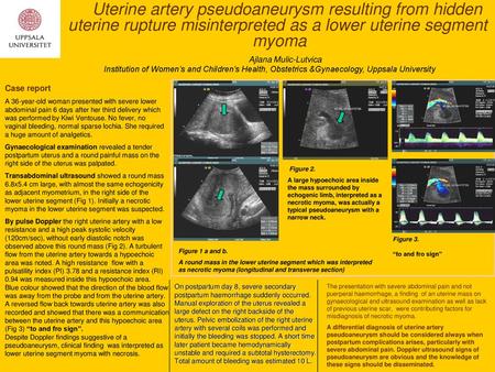 Uterine artery pseudoaneurysm resulting from hidden