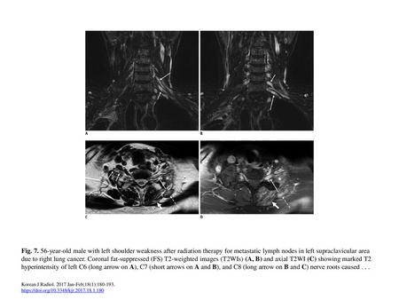 Fig. 7. 56-year-old male with left shoulder weakness after radiation therapy for metastatic lymph nodes in left supraclavicular area due to right lung.