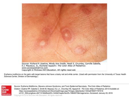 Erythema multiforme on the palm with target lesions that have a dusky red and white center. (Used with permission from the University of Texas Health Sciences.