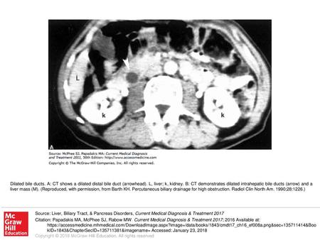 Dilated bile ducts. A: CT shows a dilated distal bile duct (arrowhead)