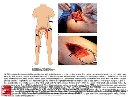 (A) This drawing illustrates axillobifemoral bypass, with a distal extension to the popliteal artery. This patient had severe ischemic change in right.