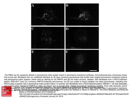 The PBDs can be caused by defects in peroxisomal matrix protein import or peroxisome membrane synthesis. Immunofluorescence microscopy shows that human.