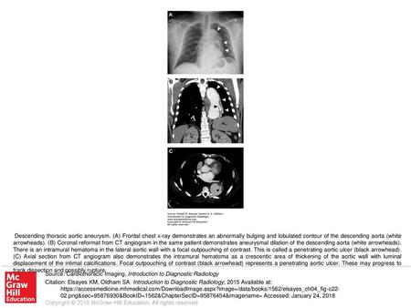 Descending thoracic aortic aneurysm