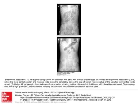 Small-bowel obstruction