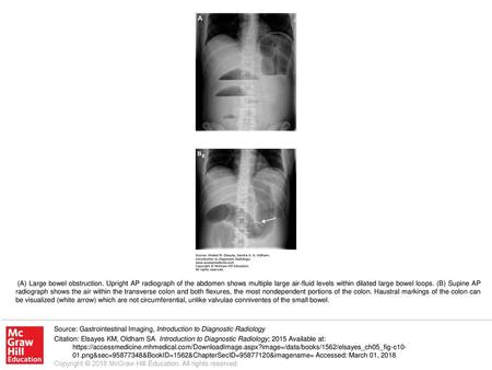 (A) Large bowel obstruction