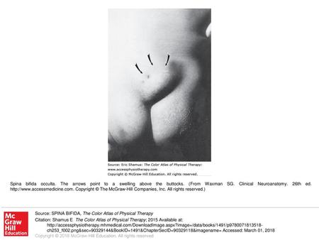 Spina bifida occulta. The arrows point to a swelling above the buttocks. (From Waxman SG. Clinical Neuroanatomy. 26th ed. http://www.accessmedicine.com.