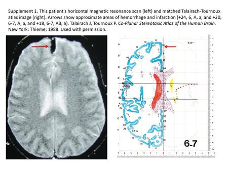 Supplement 1. This patient's horizontal magnetic resonance scan (left) and matched Talairach-Tournoux atlas image (right). Arrows show approximate areas.