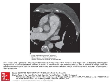 Sinus venosus atrial septal defect (ASD) and partial anomalous pulmonary venous return. Transverse axial images from a cardiac computed tomography angiogram.