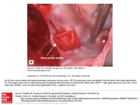 (A) A Sinus venous defect with partial anomalous pulmonary venous return. (B) The pulmonary veins are baffled to the left atrium with native pericardium.