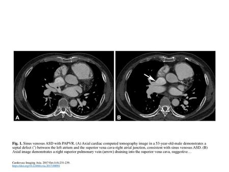 Fig. 1. Sinus venosus ASD with PAPVR