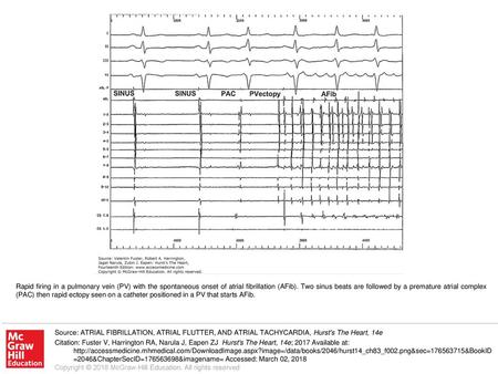 Rapid firing in a pulmonary vein (PV) with the spontaneous onset of atrial fibrillation (AFib). Two sinus beats are followed by a premature atrial complex.