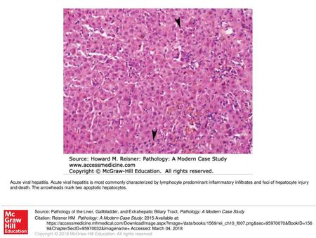 Acute viral hepatitis. Acute viral hepatitis is most commonly characterized by lymphocyte predominant inflammatory infiltrates and foci of hepatocyte injury.