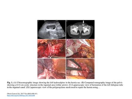 Fig. 1. (A) Ultrasonographic image showing the left hydrosalpinx in the hernia sac. (B) Computed tomography image of the pelvis showing a 6×4 cm cystic.