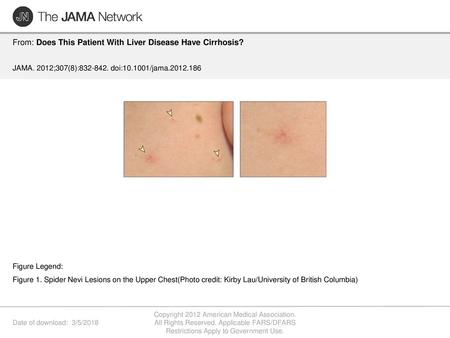 From: Does This Patient With Liver Disease Have Cirrhosis?