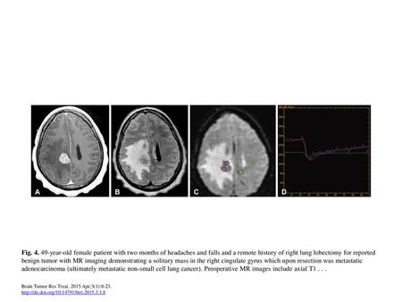 Fig. 4. 49-year-old female patient with two months of headaches and falls and a remote history of right lung lobectomy for reported benign tumor with MR.