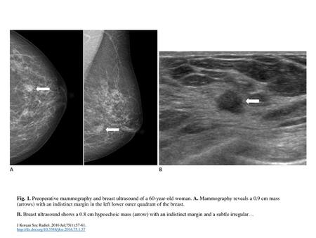 Fig. 1. Preoperative mammography and breast ultrasound of a 60-year-old woman. A. Mammography reveals a 0.9 cm mass (arrows) with an indistinct margin.