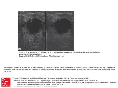 Mammogram images (A, B) indicate an irregular mass in the upper outer left breast. Ultrasound of the left breast (C) shows this to be a solid, hypoechoic.