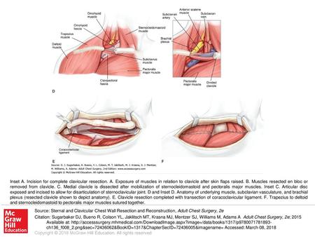 Inset A. Incision for complete clavicular resection. A