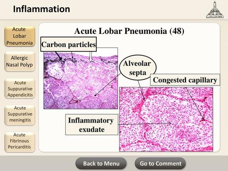 Acute Lobar Pneumonia (48)