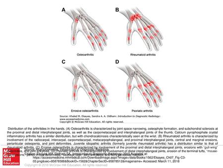 Distribution of the arthritides in the hands