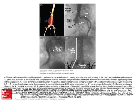 A 68-year-old man with history of hypertension and coronary artery disease (coronary artery bypass graft surgery in the past) with no follow-up in the.